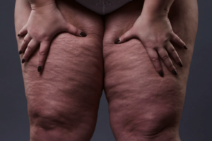 LIPEDEMA
